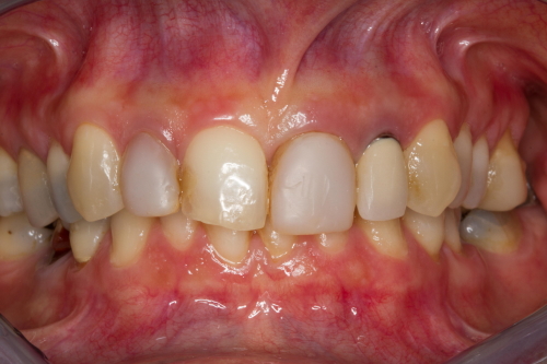 protesi-secondo-caso1