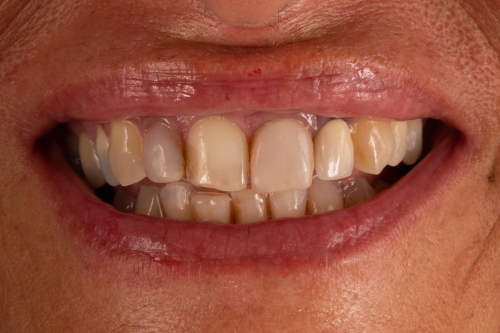 protesi-secondo-caso2