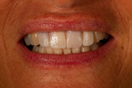 protesi-secondo-caso4