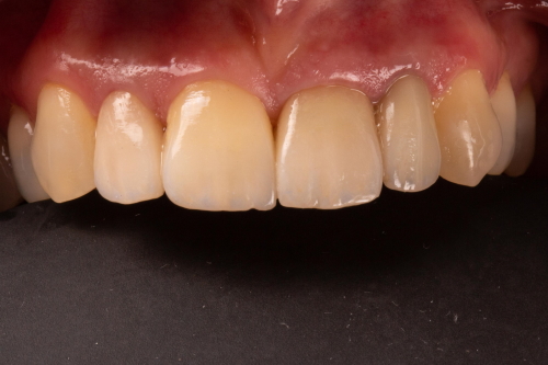 protesi-secondo-caso5