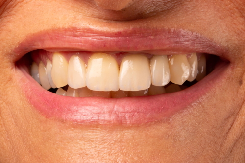 protesi-secondo-caso6