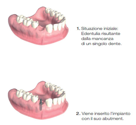 protesi impianto 1