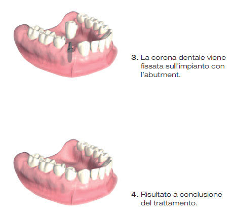 protesi impianto 2