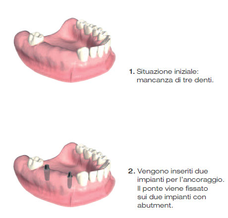 protesi impianto 3