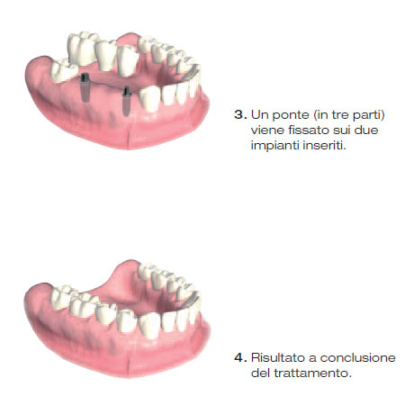 protesi impianto 4