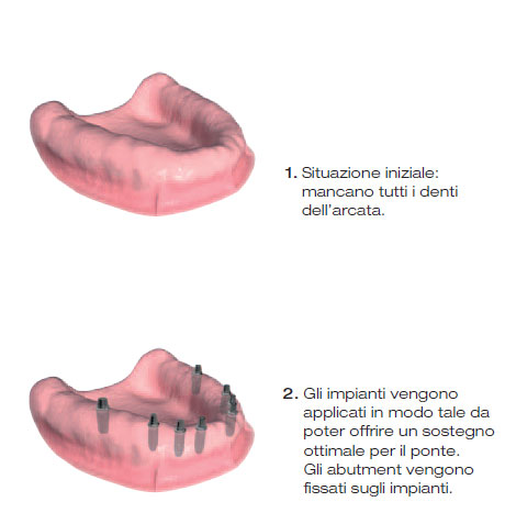 protesi impianto 5