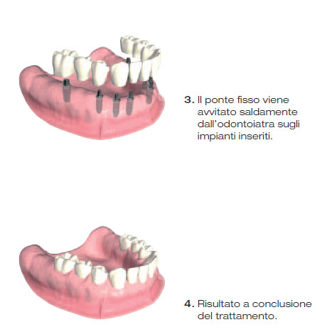 protesi impianto 6