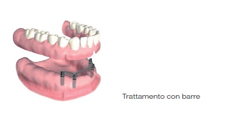 protesi impianto 7