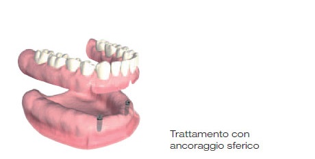 protesi impianto 8